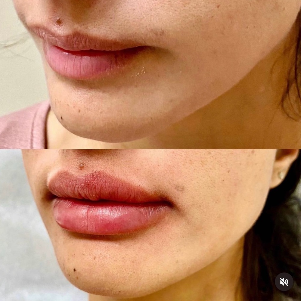 Lip 👄 filler